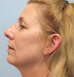 After Results for Mole Removal