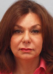 After Results for Fat Transfer