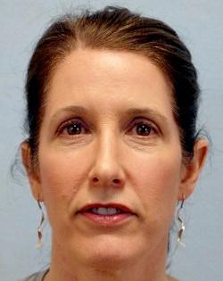 Before Results for Fat Transfer