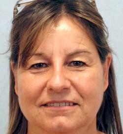 After Results for Mole Removal