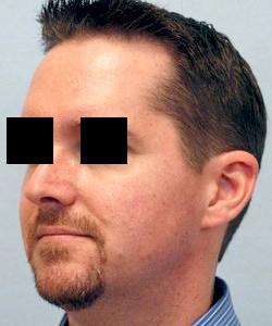 After Results for Mole Removal