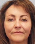 After Results for Mohs Surgery Reconstruction, Skin Cancer Reconstruction