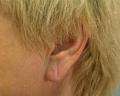 After Results for Earlobe Repair