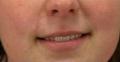 After Results for Mole Removal