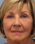 After Results for Laser Skin Resurfacing