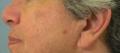 After Results for Laser Skin Resurfacing