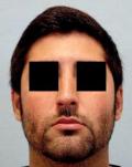Before Results for Rhinoplasty