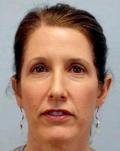 Before Results for Blepharoplasty, Fat Transfer