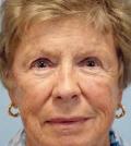 Before Results for Laser Skin Resurfacing