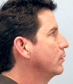 After Results for Chin Implant