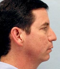 Before Results for Chin Implant