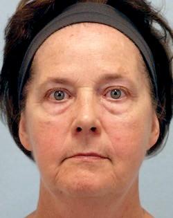 Before Results for Blepharoplasty