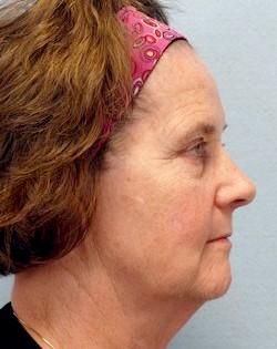 Before Results for Laser Skin Resurfacing