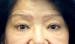 After Results for Blepharoplasty