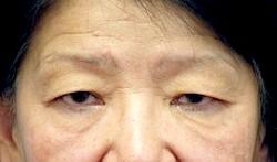 Before Results for Blepharoplasty