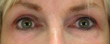 After Results for Blepharoplasty