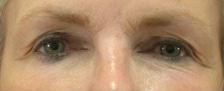 Before Results for Blepharoplasty