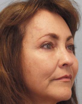 After Results for Mohs Surgery Reconstruction