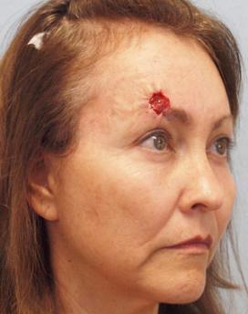 Before Results for Mohs Surgery Reconstruction, Skin Cancer Reconstruction