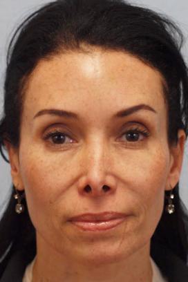 Before Results for Juvederm