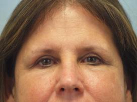 After Results for Blepharoplasty, Laser Skin Resurfacing, Fat Transfer