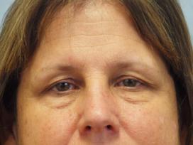 Before Results for Blepharoplasty, Laser Skin Resurfacing, Fat Transfer