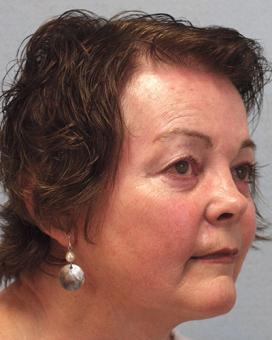 After Results for Mohs Surgery Reconstruction, Skin Cancer Reconstruction