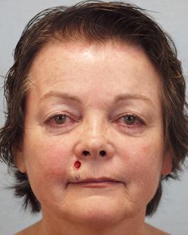 Before Results for Mohs Surgery Reconstruction