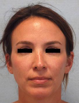 After Results for Rhinoplasty