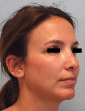After Results for Rhinoplasty, Chin Implant