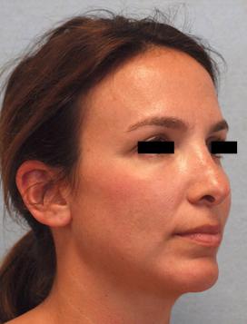 After Results for Rhinoplasty