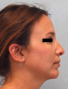 After Results for Rhinoplasty, Chin Implant