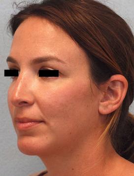 After Results for Rhinoplasty, Chin Implant