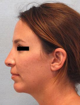 After Results for Rhinoplasty, Chin Implant