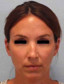 Before Results for Rhinoplasty