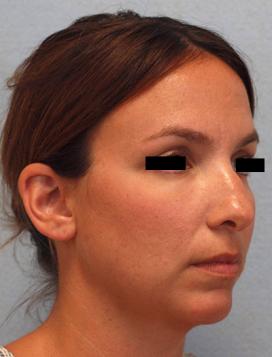 Before Results for Rhinoplasty, Chin Implant