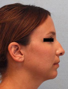 Before Results for Chin Implant