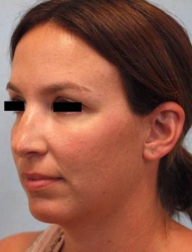 Before Results for Rhinoplasty, Chin Implant