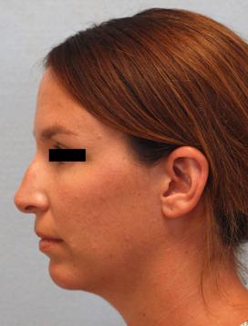 Before Results for Rhinoplasty, Chin Implant