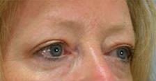 After Results for Blepharoplasty