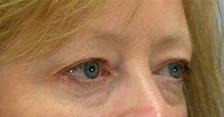 Before Results for Blepharoplasty