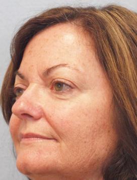 After Results for Nose Reconstruction