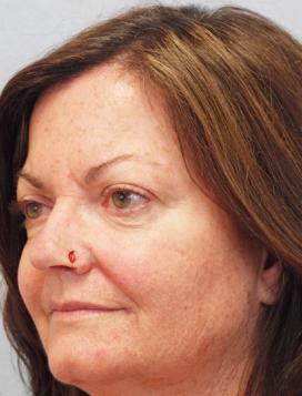 Before Results for Mohs Surgery Reconstruction, Skin Cancer Reconstruction, Nose Reconstruction