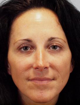 Before Results for Juvederm, Lip Augmentation