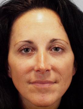 Before Results for Lip Augmentation