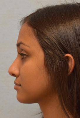 After Results for Rhinoplasty