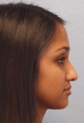 Before Results for Rhinoplasty