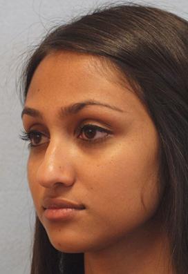 Before Results for Rhinoplasty