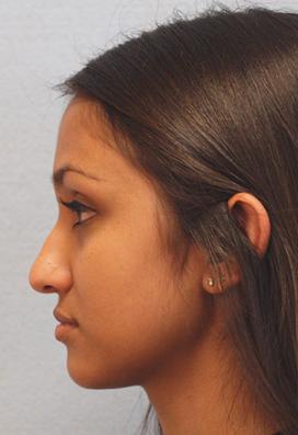 Before Results for Rhinoplasty