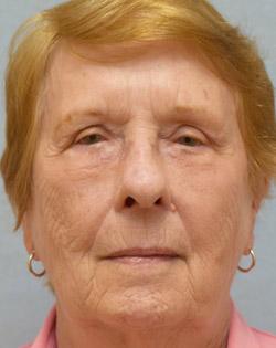 After Results for Blepharoplasty